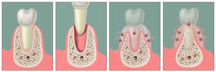 Bone Grafting Central London