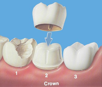 Porcelain Crowns