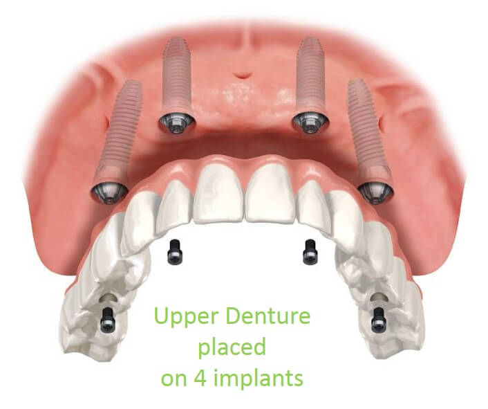 Denture over Implants Central London