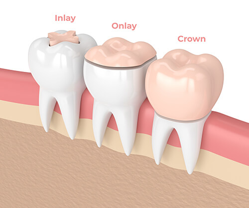 Inlays/Onlays Victoriapark Dental