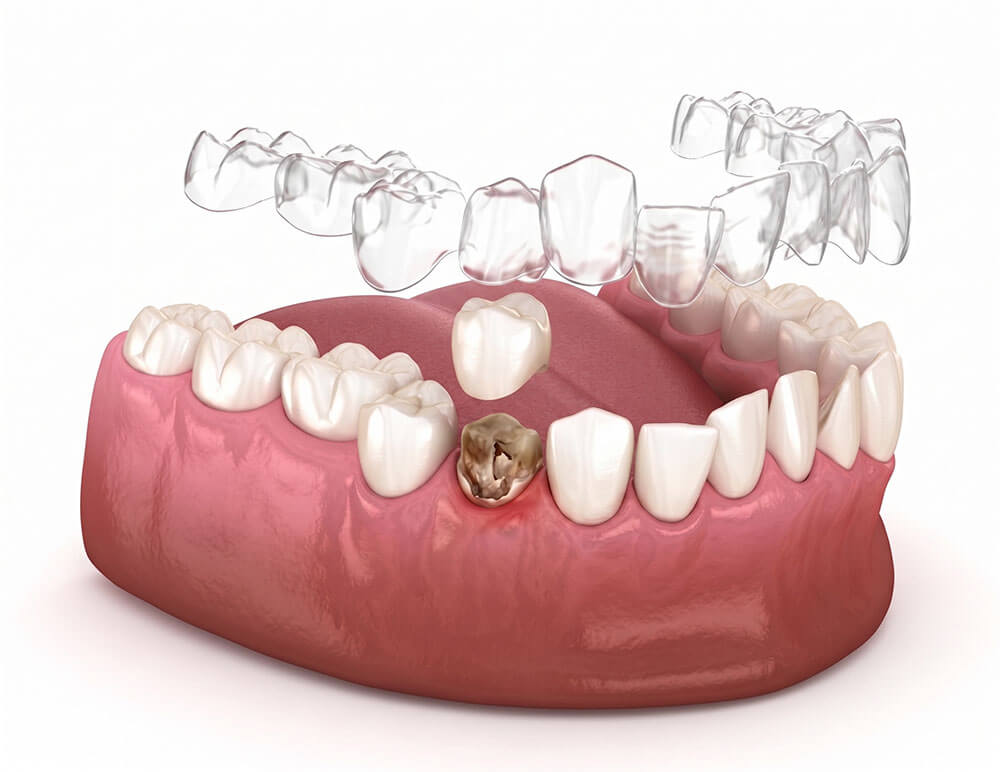 Invisalign aligner with dental crown illustration
