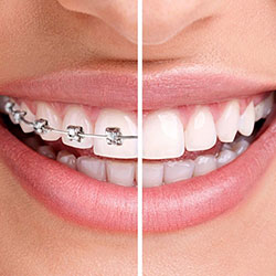 Traditional Braces