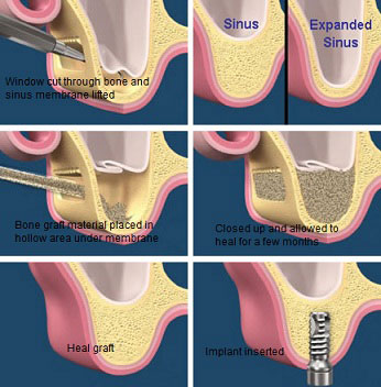 Sinus Lift Steps