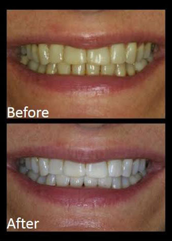 Whitening Before-After