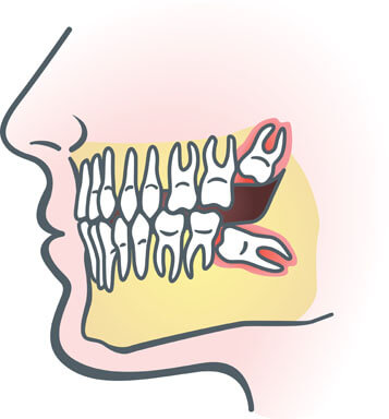 Image of misaligned wisdom teeth
